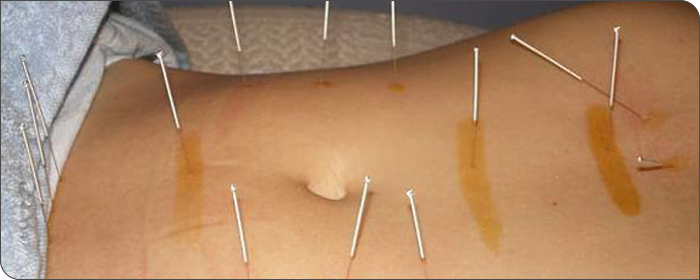 acupunture-banner