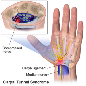 Carpal Tunnel Syndrome Treatment Mississauga
