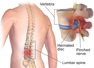 Lower back pinched nerve