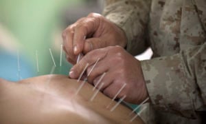 Acupuncture