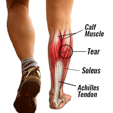 Calf muscle strain- cause, symptoms and treatment.