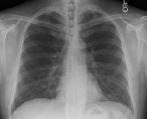 Physiotherapy Treatment for Chest