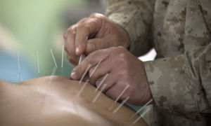 Suffering from Lower Back Pain? Acupuncture can help!